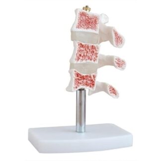 Kifidis Orthopedics Ossa con osteoporosi