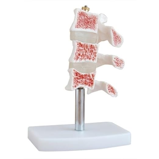 Kifidis Orthopedics Ossa con osteoporosi